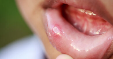 Por qué aparecen llagas en la boca y cómo curarlas
