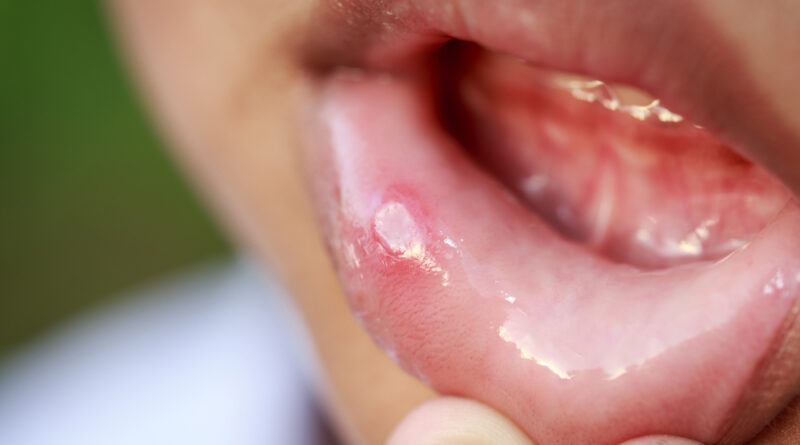 Por qué aparecen llagas en la boca y cómo curarlas